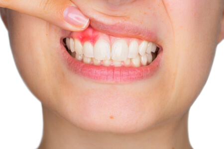 Zahnfleischentzündung (Parodontitis) führt zu einer Infektion des Zahnbettes und kann zu Schmerzen, gelockerten Zähnen und langfristig zu ernsthaften gesundheitlichen Problemen führen.